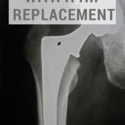 One of my biggest fears having hip replacement surgery was not knowing what recovering from a hip replacement feels like. Here's what to expect recovering from a hip replacement.