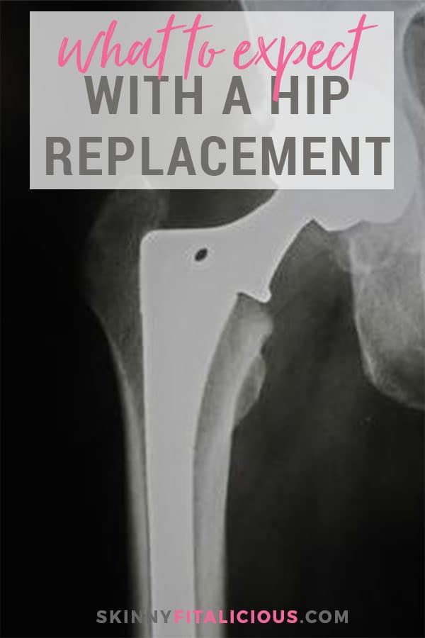 One of my biggest fears having hip replacement surgery was not knowing what recovering from a hip replacement feels like. Here's what to expect recovering from a hip replacement.